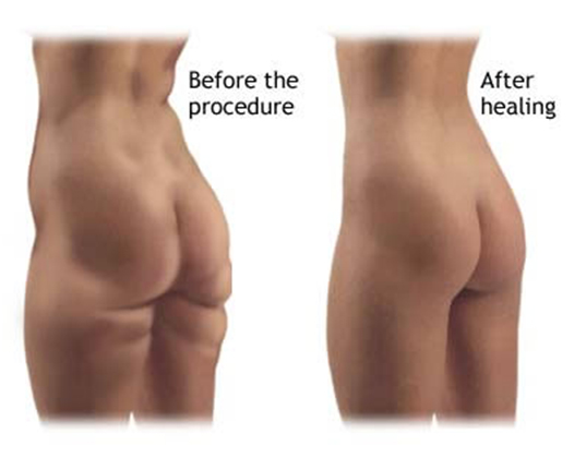 liposuction Las Vegas